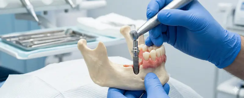 İmplant Tedavisi